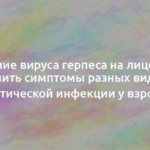 Лечение вируса герпеса на лице: чем лечить симптомы разных видов герпетической инфекции у взрослых 