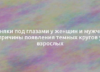 Синяки под глазами у женщин и мужчин: причины появления темных кругов у взрослых 