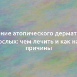 Лечение атопического дерматита у взрослых: чем лечить и как найти причины 