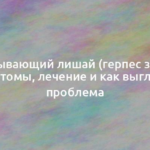 Опоясывающий лишай (герпес зостер): симптомы, лечение и как выглядит проблема 